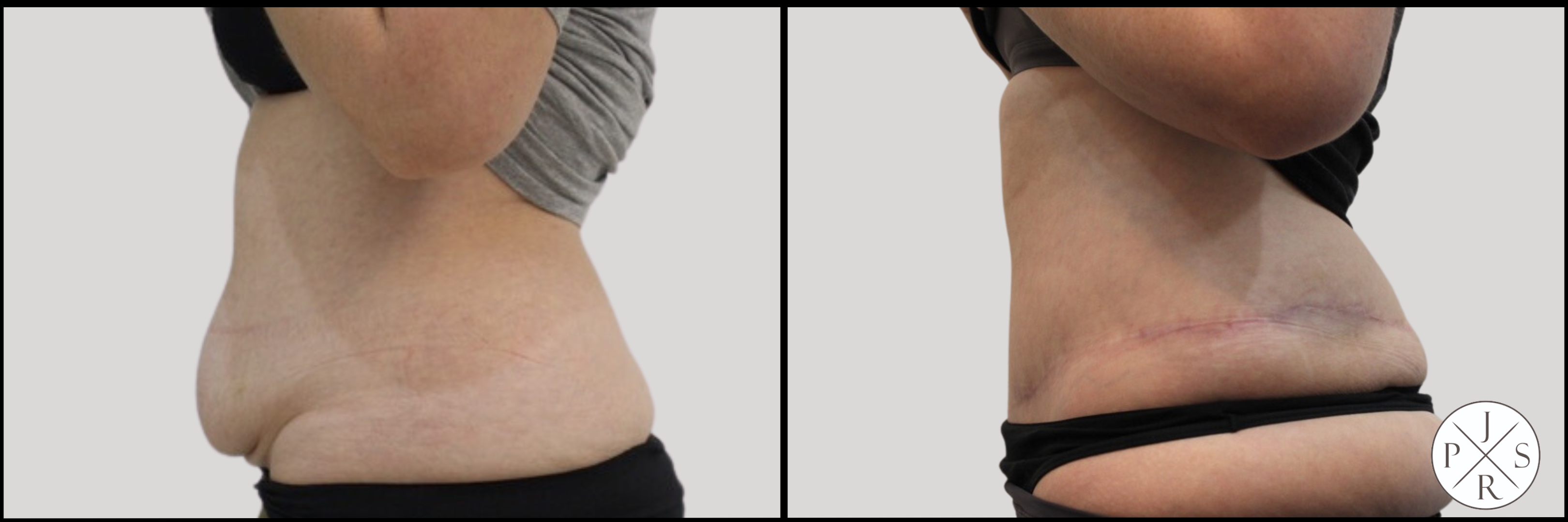 Abdominoplasty Before & After Image